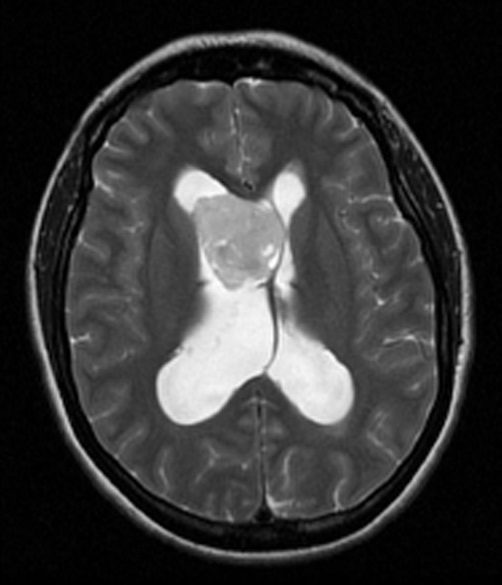 Fig. 8: Neurocitoma central. Imagen de RM axial potenciada en T2.