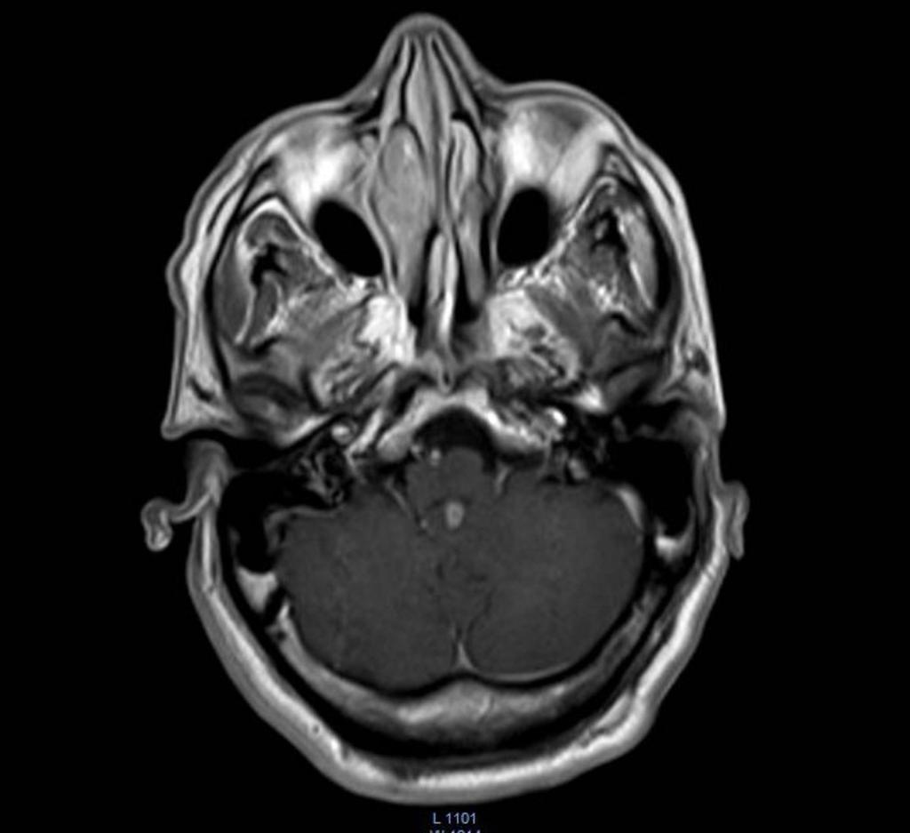 Fig. 3: Subependimoma: Imagen de RM axial potenciada en T1 con contraste del mismo paciente que en la figura