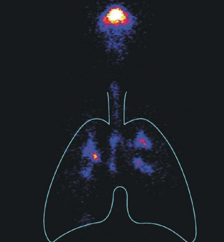 Imágenes de depósito pulmonar por escintigrafía de B2 antes y