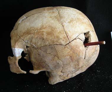 de la sutura lambdoidea con apoyo directo de la pistola sobre el cráneo y