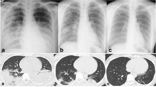 Acute Fibrosis Organizing Pneumonía (AFOP), variante fibrótica/cicatricial de la neumonía organizativa (postinfecciosa). Sde. de distress respiratorio secundario a AFOP.