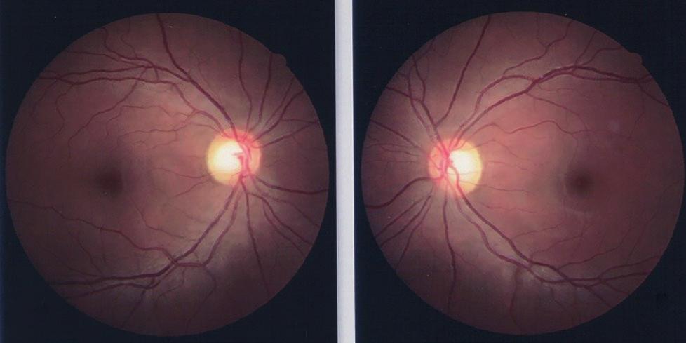 A B Figura 1. Retina.