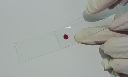 Extensiones sanguíneas y técnicas hematológicas 63 3. Una vez que el portaobjetos toca la muestra, la sangre difunde por todo el ancho del portaobjetos.