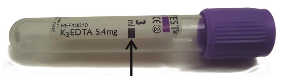 gota gruesa y tinción de Giemsa para el diagnóstico de malaria. 3.