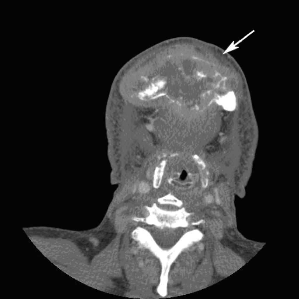 Fig. 22: Paciente con tumor en suelo de la boca con extensa infiltración ósea.