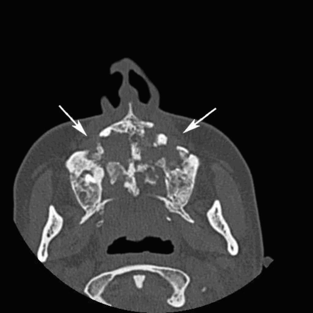 Fig. 4: Paciente con antecedentes de neoplasia de cavum indiferenciado en 1996. Recibió QT y RT. TC de fosas y senos paranasales. Ventana de hueso. Plano axial.