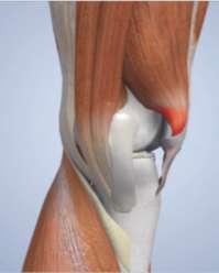 gel Ruptura ligamento colateral lateral Ruptura menisco lateral Bursitis anserina