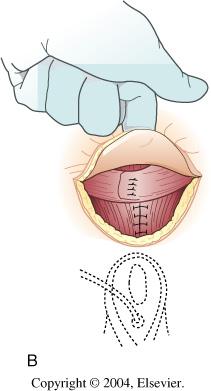 Las personas que experimentan una incontinencia intestinal que no responde a los tratamientos médicos, pueden requerir una intervención quirúrgica para corregir la disfunción.