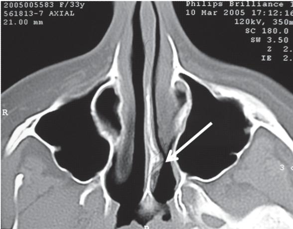 Figura 2. Radiografia del femur izquierdo y pelvis (2001). Flecha: exostosis pelvica. Asterisco: exostosis femoral. Figura 4.
