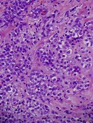 Respuesta parcial a neoadyuvancia con ganglio centinela postneoadyuvancia con células tumorales aisladas.