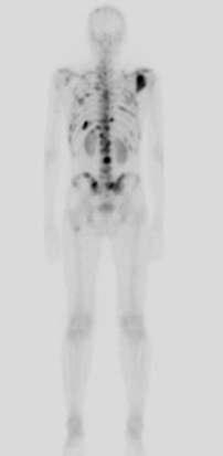 Bone Metastases Very Common in Cancer Estimated incidence (%) 1,a Myeloma 70-95 Renal 20-25 Melanoma 14-45 Bladder 40 Thyroid 60 Lung 30-40 Breast 65-75 Prostate 65-75 It is estimated that > 350,000
