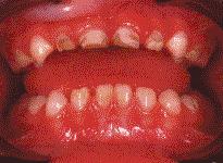 Otras complicaciones Apiñamiento de dientes Respiración n bucal Deformaciones