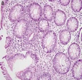Irritación peritoneal Íleo Colonoscopic view of bowel edema and