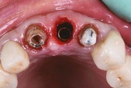 fractura del diente 2 3 Extracción del diente