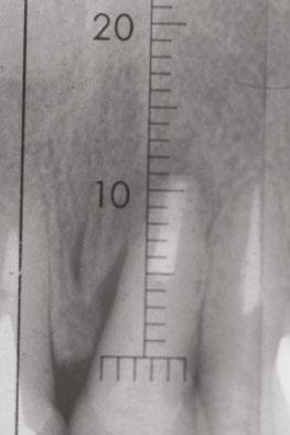 4 Imagen de la radiografía endoral Fig.