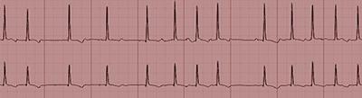 Definición y tipos de FA La FA se define como una arritmia cardiaca con las siguientes características con unas características electrocardiográficas definidas: 1.