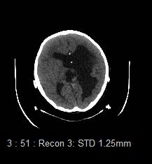 TAC cerebral Dilatación de ventrículos laterales con predominio
