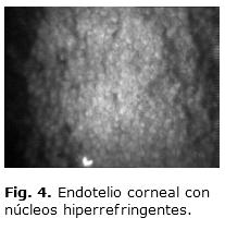 Presenta microscopia confocal normal (Fig. 5).