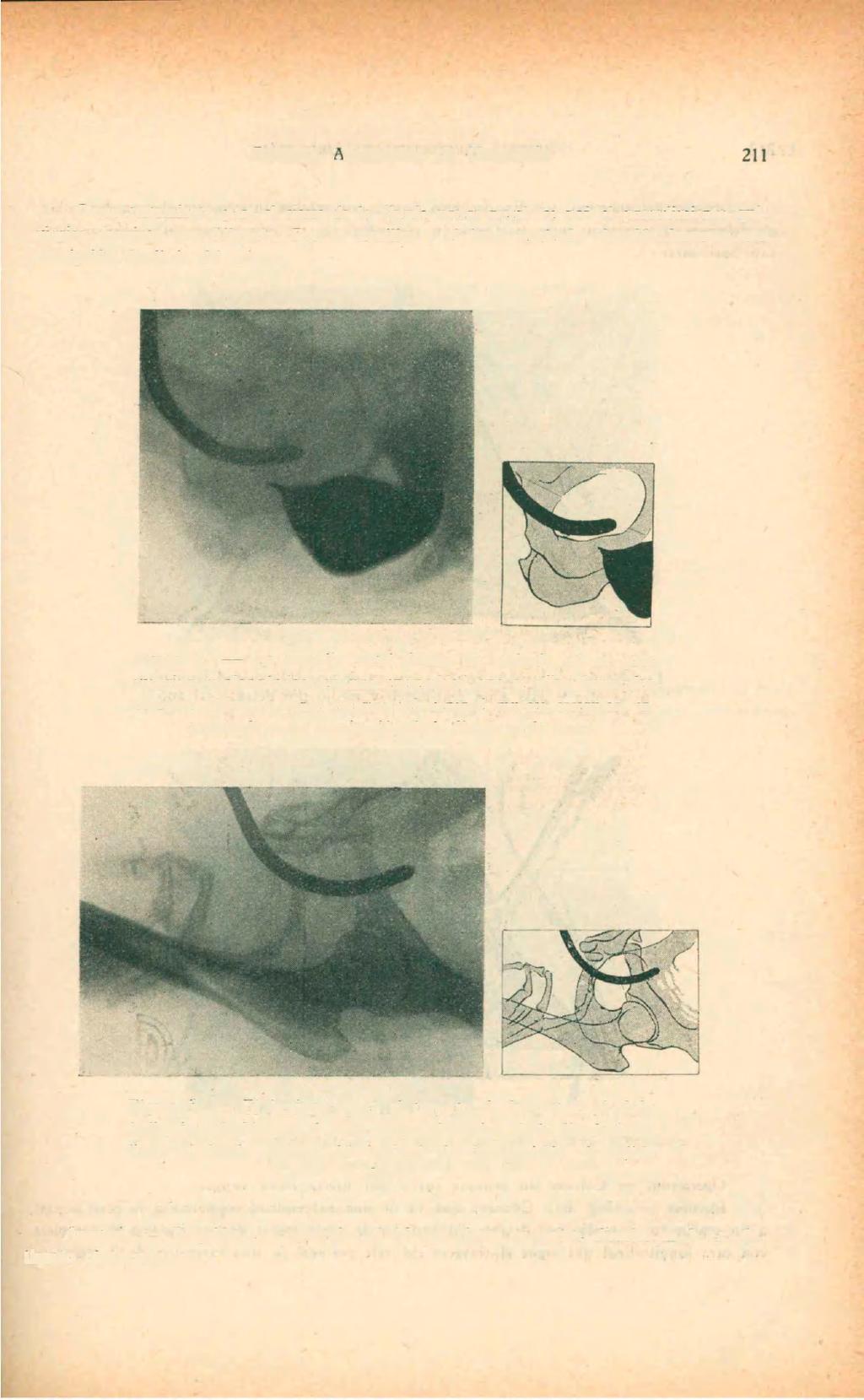 211 REVISTA ARGENTINA DE UROLOGÍA Como tratamiento para el cierre de la fístula uretro-rectal, se usó el procedimiento quirúrgico descripto por Albarrán.