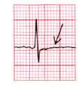 La onda T, constituye la parte final de la actividad cardíaca eléctrica, y también un punto importante para el despistaje de isquemia, disionías, intoxicaciones farmacológicas, etc.