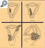 CARACTERISTICAS Puede surgir en cualquier porción del endometrio Circunscrito