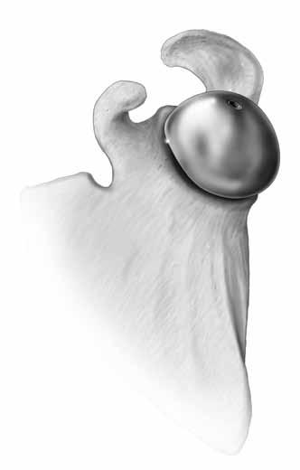 La estabilidad del implante se valora durante una reducción de prueba y, para ello, se valora el arco de movimiento del hombro.