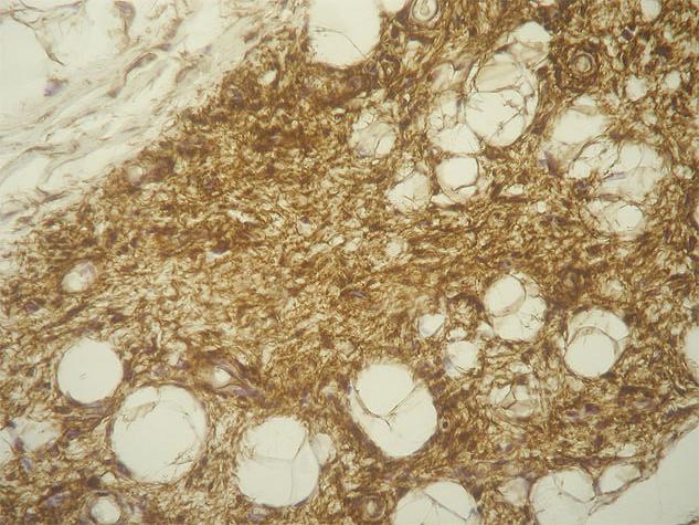 Página 9 de 10 CD34 x40 - Las células fusiformes son positivas para CD34 Discusi ón El mixofibrolipoma dendrítico es una tumoración poco frecuente y recientemente descrita de partes blandas.