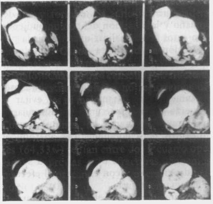 Fig. 5. Resonancia magnética nuclear. Hemangioma de muslo. Fig. 4. Tomografía axial computada. Fibrosarcoma de base de cráneo.