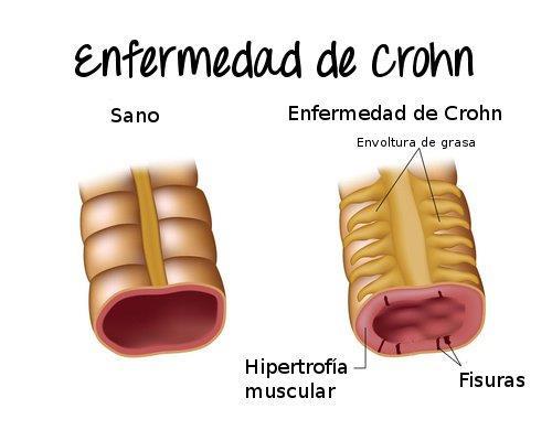 CAUSAS La causa exacta de la enfermedad de Crohn se desconoce.
