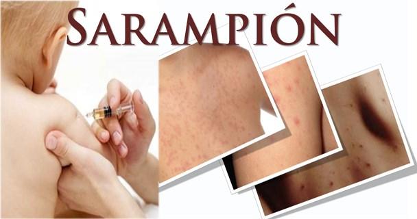 El sarampión es una enfermedad vírica, contagiosa (R0 18), con cuadro clínico caracterizado por presencia de fiebre, conjuntivitis, coriza, tos y manchas pequeñas con centro blanco o blanco azulado
