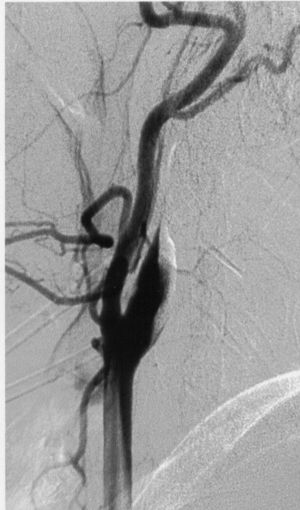 Tratamiento con endoprótesis y espirales de un pseudoaneurisma asociado a una estenosis en la arteria carótida interna 2005; 16: 528-532 las limitaciones iniciales fueron mayores que en el sector
