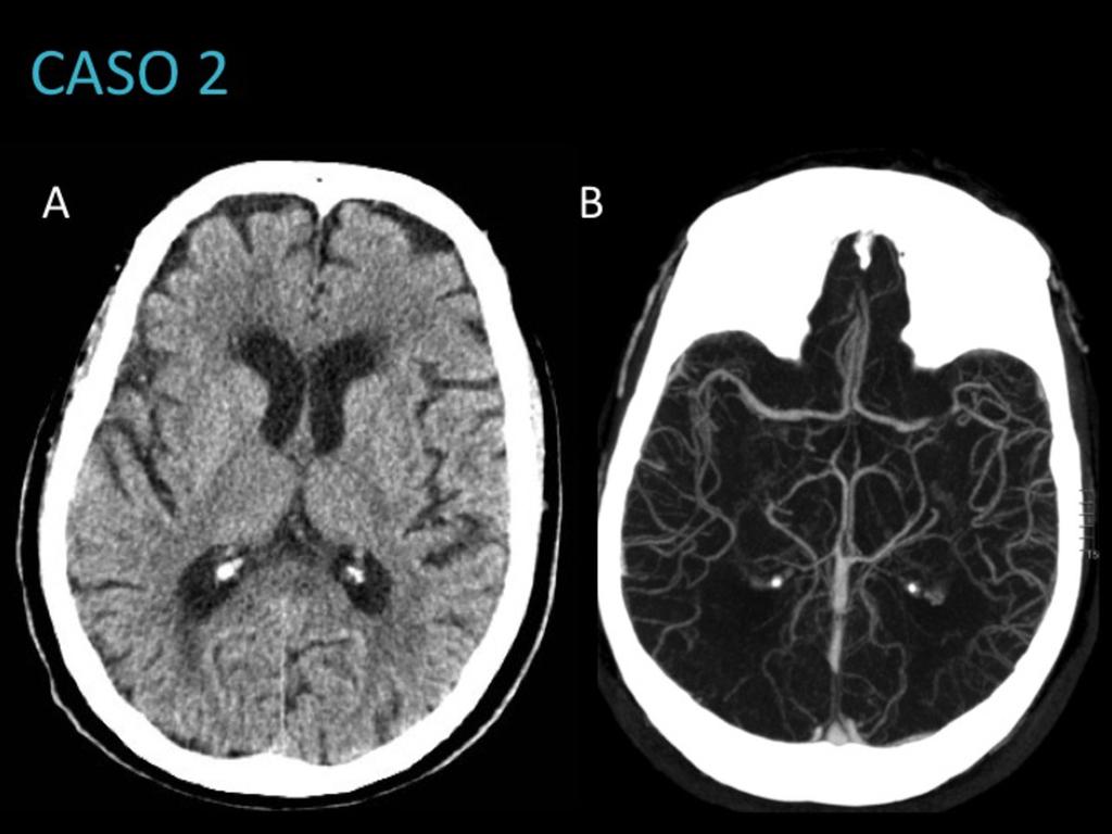 Fig. 15: Mujer de 82 años con clínica hemisférica izquierda de inicio indeterminado (Ictus del despertar), con una puntuación clínica NIHSS=14.