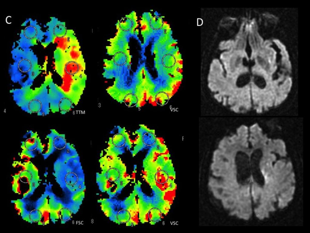 Fig. 16: Los mapas de perfusión cerebral (C) señalan isquemia completa del territorio de la ACM con VSC aumentado compensatorio y sin aparentes infartos establecidos.