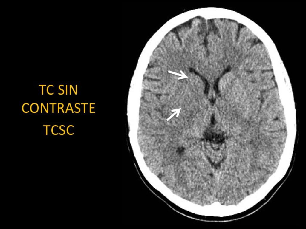 Fig. 2: El rol del TCSC es la exclusión del ictus hemorrágico y la detección de otras patologías (como una neoplasia cerebral) que podrian ser la causa de déficit neurológico.