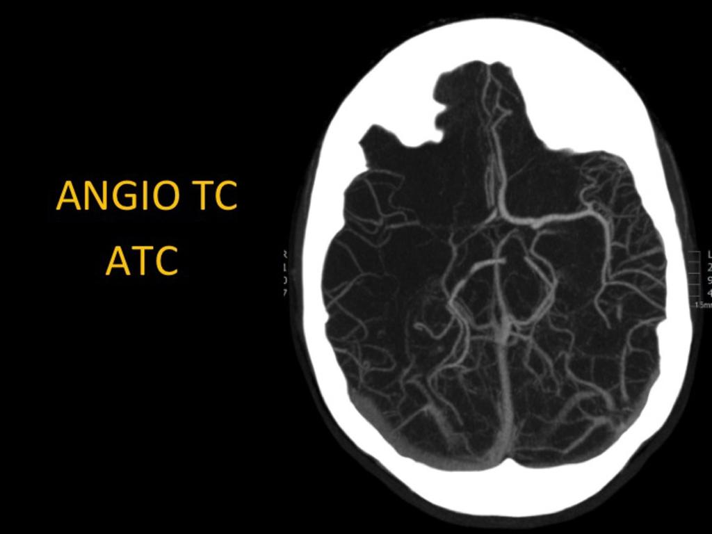 Fig. 3: El objetivo del ATC es mostrar la angioarquitectura de los vasos extra e intracraneales.