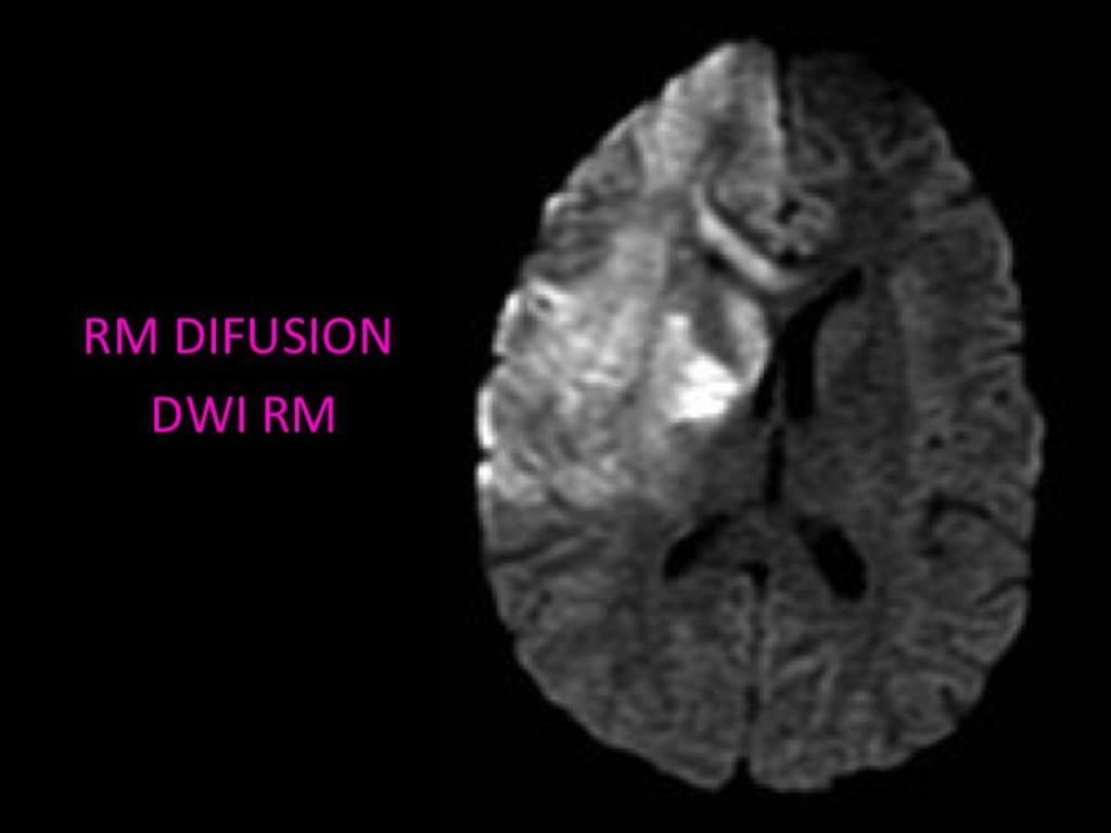 Fig. 7: La difusión por RM, es el metodo de diagnóstico por imagen más fiable para la detección de tejido isquemico infartado.