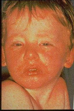 Sarampión Ruta de infección: gotas de secreción nasofaríngea (grandes gotas y aérea) Riesgo de infección: TS sin evidencia de inmunidad 1985 1991: 3.