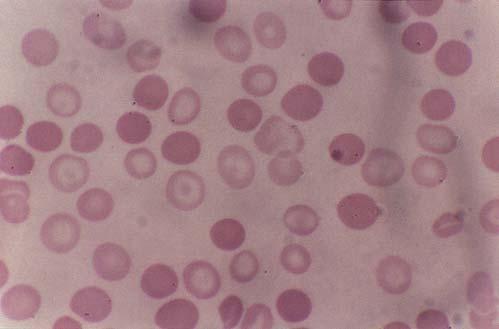 Hematología Morfología sangre periférica: poiquilocitos (hematíes de formas variadas) y dianocitos, si la anemia es importante. Reticulocitos normales o : aumentan rápidamente con el tratamiento.