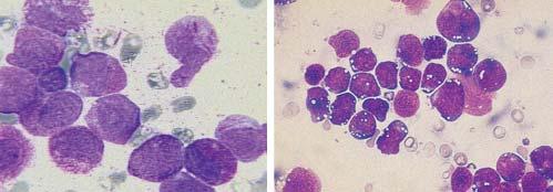 Concepto Proliferación neoplásica clonal de células precursoras incapaces de madurar (blastos) en médula ósea que produce un descenso de las células normales de las tres series hematopoyéticas