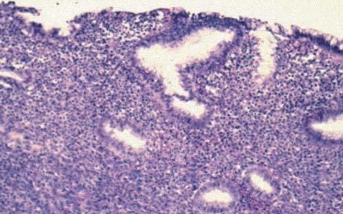 Histología Tienen un patrón característico de células medianas con crecimiento difuso, con intensa sobreexpresión de inmunoglobulinas de superficie de tipo B (CD19 y CD20) junto a un antígeno de