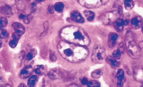 cadenas pesadas de inmunoglobulinas. - Cadenas gamma (Hγ) o enfermedad de Franklin: linfoma en el anillo linfático de Waldeyer. Tienen infecciones de repetición. Evolución agresiva.