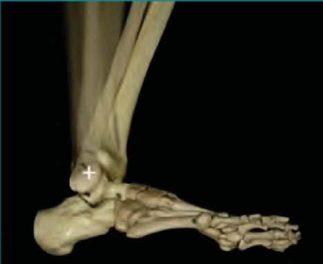 Osteotomía de Scarf: 3. Chevron más Akin: 3. Osteotomía de Scarf más Akin: 2. Hubo las siguientes complicaciones: Figura 2. Segundo rocker: apoyo. Rigidez (dedo flotante): 7.
