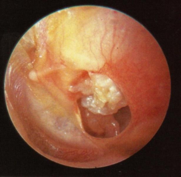 ONNs media crónica Perforación marginal o amcal Anillo Mmpánico erosionado Mucosa con