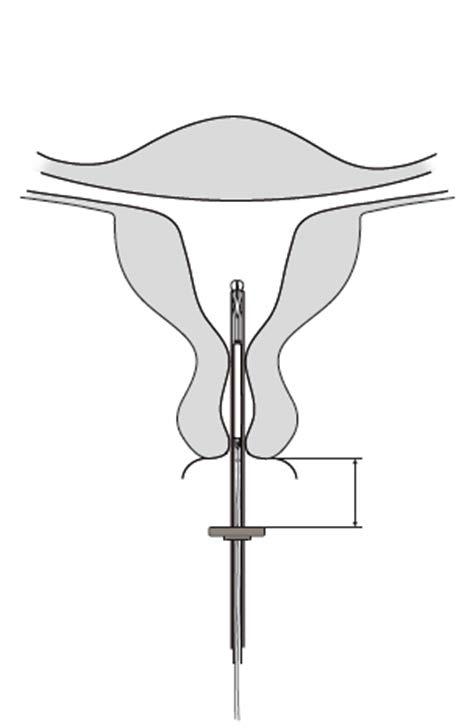 3. Sujetando la corredera en el final de su recorrido, colocar el borde superior de la pestaña a la longitud de la cavidad uterina medida con la sonda (Figura 3). Figura 3 4.
