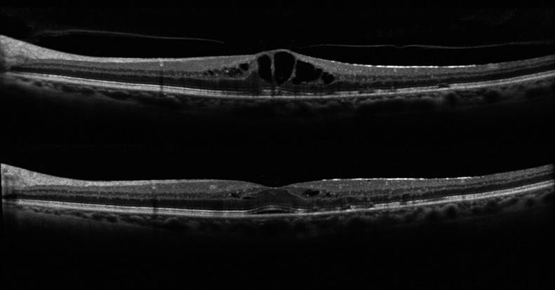 Tracción vitreomacular. Del optimismo del uso de la ocriplasmina y la inyeccion de gas intraocular a la realidad en la clinica diaria en ambos ojos con una leve blefaritis posterior.