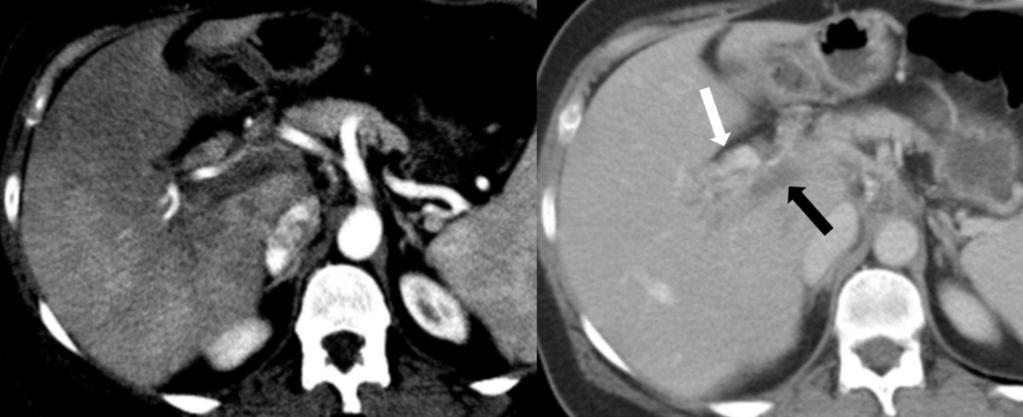 Fig. 6: Trombosis de vena porta por trombofilia. Imágenes axiales de TC en fase arterial (izquierda, ventana forzada) y en fase portal.