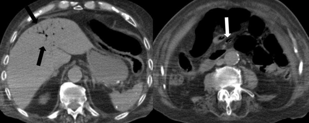 (flecha). Derecha: RM secuencia T2 en coronal, permite ver claramente la trombosis tumoral en vena porta principal muy dilatada en hilio hepático (entre flechas).