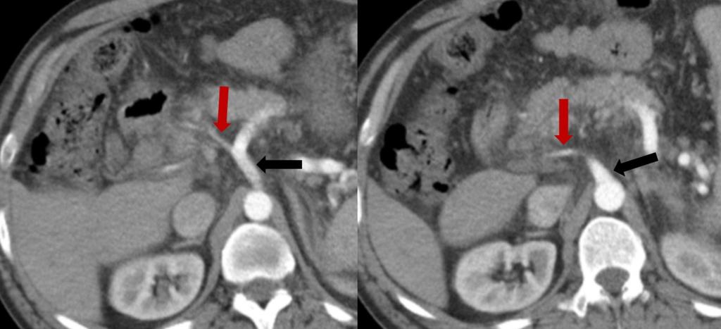 Fig. 10: Variante normal de arteria hepática. TC con contraste en fase arterial. Imagen izquierda: la AHI (flecha roja) surge del tronco celíaco (flecha negra).