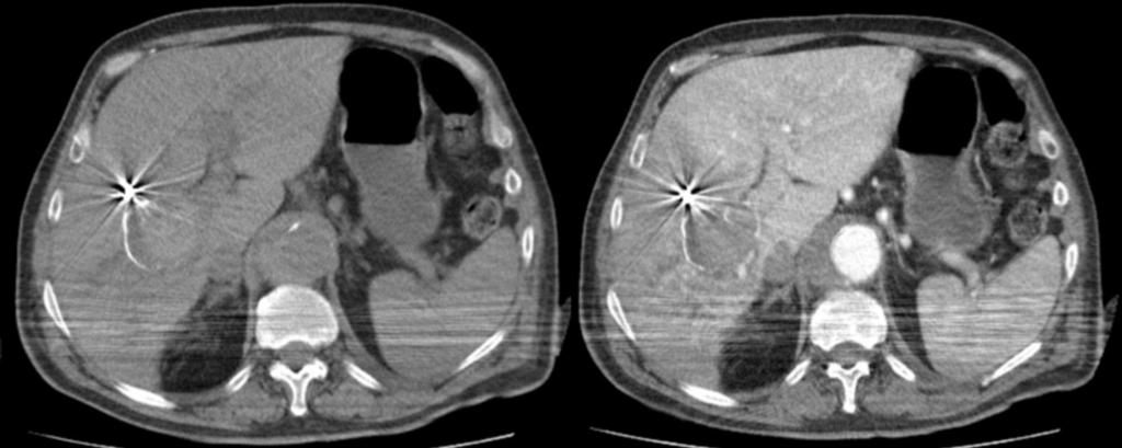 mediante embolización con coils (derecha). Fig. 13: Aneurisma de arteria hepática derecha, un mes después del tratamiento endovascular (mismo paciente).