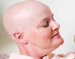 TRICOLOGÍA Alopecia androgenética